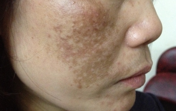 Cách sử dụng sản phẩm trị nám hiệu quả như quảng cáo