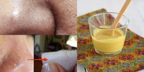 Uống loại nước này, mụn nào cũng ra đi vĩnh viễn chỉ sau 1 tuần