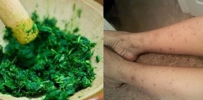 Chân chi chít sẹo thâm (do muỗi đốt) cũng phải trắng sáng ngay tức khắc nếu sử dụng cách này trong 1 tuần