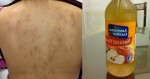 BÍ KÍP TRỊ MỤN Ở LƯNG CHỈ VỚI NGUYÊN LIỆU CHƯA ĐẾN 10k, BẠN BIẾT CHƯA?