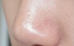 Cách trị DỨT ĐIỂM mụn cám ở mũi chỉ với 25 phút tại nhà