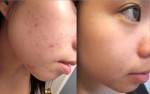 Tôi đã hết sạch thâm mụn chỉ trong 2 tuần nhờ bí kíp của mẹ