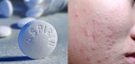 Mụn trứng cá nhan nhãn trên mặt cũng hết ngay chỉ bằng 1 viên aspirin
