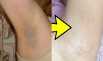Biến nách từ thâm đen đầy lỗ chân lông thành trắng mịn chỉ tốn vỏn vẹn 5 ngàn đồng