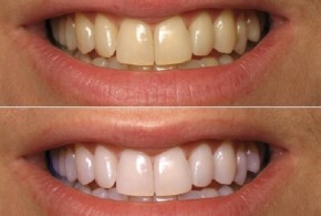 Chà vỏ chanh lên răng mỗi đêm trước khi đi ngủ, điều kỳ diệu sẽ xảy ra vào sáng hôm sau