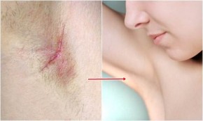 Biến nách từ thâm đen đầy lỗ chân lông thành trắng mịn chỉ tốn vẻn vẹn 5 ngàn đồng