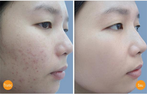 Làn da bất ngờ trắng nõn nhờ công thức từ 1 quả chuối chín