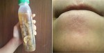 Tự làm "nước thần" để diệt sạch mụn li ti, mụn ẩn tại nhà