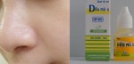 Xóa hết các nốt thâm do mụn gây nên chỉ bằng 1 lọ dầu mù u 5k có đầy ngoài tiệm