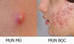 Nặn mụn như thế nào để không sưng viêm lại nhanh lành