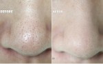 Trị dứt điểm lỗ chân lông to nhờ bia, tỏi và rượu trắng