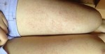 Em đã thoát khỏi nỗi ám ảnh chân bị lỗ chân lông đen xì rồi các mẹ ơi!