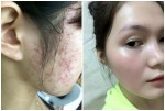 Không cần bôi trét mỹ phẩm lên da, nhân mụn vẫn tiêu sạch