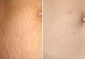 Cách trị rạn da sau sinh cho các mẹ chỉ bằng 1 quả chanh