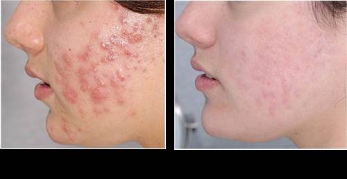 Trị mụn với bột đậu xanh vừa nhanh vừa dễ hết ngay trong 1 tuần
