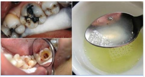 Không cần dùng thuốc kháng sinh đâu, nếu đau răng, ê buốt, sưng nướu không ngủ được hãy ngậm ngay thứ này