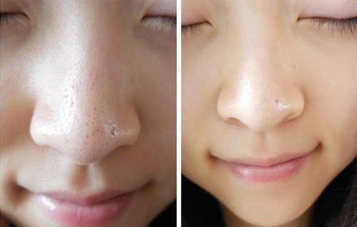 Một nắm rau diếp cá, mụn đầu đen tự khắc chui ra chỉ trong 30 phút