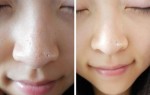 Một nắm rau diếp cá, mụn đầu đen tự khắc chui ra chỉ trong 30 phút