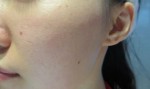Mình tự tin khẳng định đã trị mụn thành công sau 1 tháng