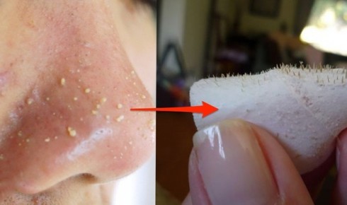 6 mẹo nhỏ giúp bạn trị “mụn mọc trên mũi” hiệu quả tại nhà
