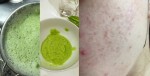 4 cách đơn giản để mụn ẩn tự trồi lên khỏi cần nặn