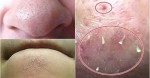 Cách diệt tận gốc mụn đầu đen ở cằm và 2 bên cánh mũi chỉ sau 1 lần sử dụng, cực dễ làm