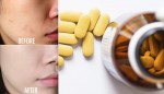 Dùng vitamin B1 theo công thức này da trắng bật tông tạm biệt vết thâm, nám