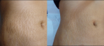 Rạn da sau sinh, chồng chê da như tấm bản đồ, xài cách này chồng hết chê bai xài xể
