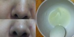 Bí quyết trị mụn đầu đen, lỗ chân lông to (em đã thành công & có hình ạ)