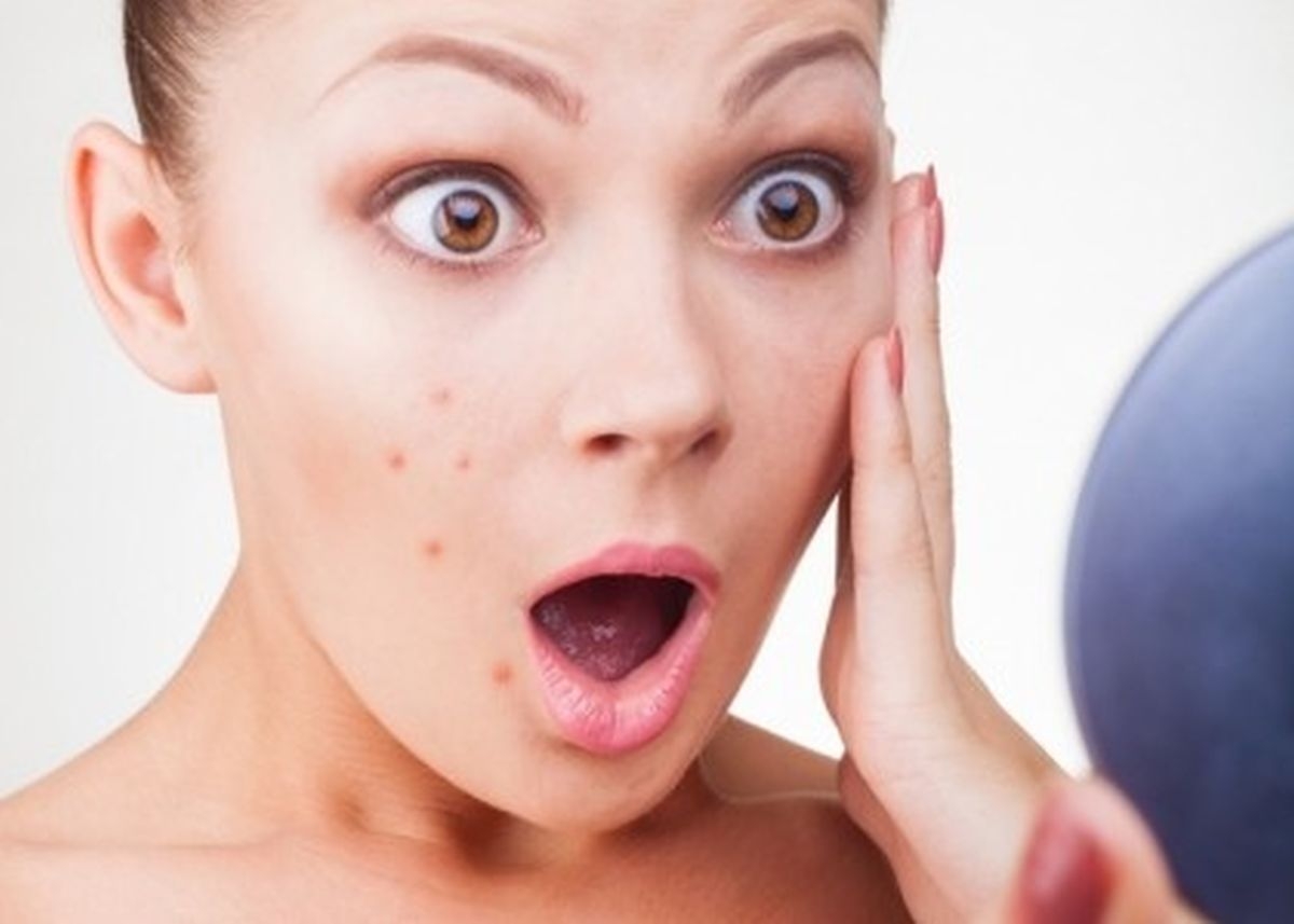 Làm sạch mụn trứng cá mỗi ngày với cây chó đẻ