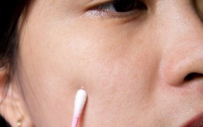 Mụn thịt "một đi không trở lại" mà không cần laser bằng 1 mẹo thiên nhiên cực hay