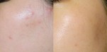 4 cách để mụn ẩn tự trồi lên khỏi mất công nặn