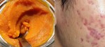 Sẹo nào cũng chữa khỏi chỉ bằng công thức đơn giản sau