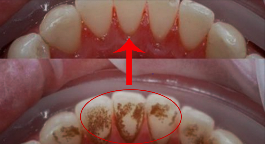Cả đời sẽ không cần đi lấy cao răng nếu súc miệng nước này trước khi ngủ