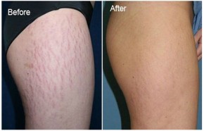 Rạn da đến đâu cũng sẽ mờ dần rồi biến mất hẳn với 7 cách này