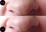 Tổng hợp cách trị mụn đầu đen hiệu quả, an toàn, nên biết ngay hôm nay!