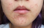Trộn 2 thứ này lại với nhau rồi thoa lên da, mụn cám nhiều cũng sạch bách hơn gel lột mụn