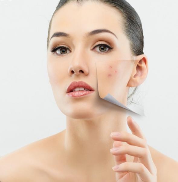 Thần dược trị sẹo rỗ, sẹo lõm khiến chị em ai cũng ngã mũ thán phục