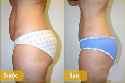 Công thức triệt tiêu mỡ bụng nhanh hơn cả đi hút mỡ