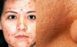 Cách trị mụn và thu nhỏ lỗ chân lông hiệu quả nhất mọi phụ nữ nên biết