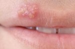 12 cách loại bỏ mụn rộp tại nhà cực dễ, ai cũng tự làm được