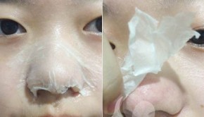 Trị mụn đầu đen với mặt nạ “thần thánh” chỉ từ 1 nguyên liệu duy nhất