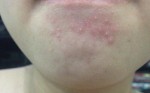 Đây là hình em hết mụn nhờ chà vỏ chuối lên da
