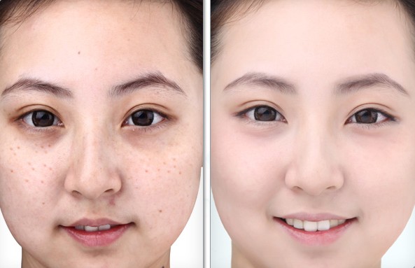 Tin sốc: 4 loại vỏ trị sạch nám tối đa dễ dàng ai cũng thấy nhưng không ai biết dùng