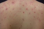 Mụn bao nhiêu cũng biến mất nhờ tắm với thứ nước này