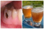 Bài thuốc dân gian trị sâu răng, răng lung lay ê buốt chỉ 1 ngày là dứt