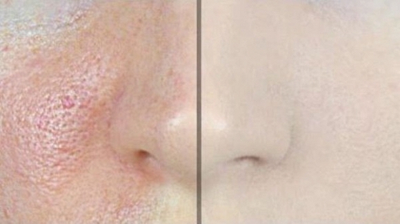 Thu nhỏ lỗ chân lông to cho da nhờn chỉ với 2-3 lần thực hiện