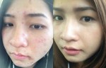Diệt sạch thâm nám, tàn nhang chỉ bằng 1 nắm lá ngải cứu và kinh giới