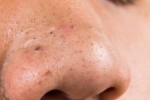 Mụn đầu đen bay sạch không cần nặn chỉ cần thoa thứ này lên mũi 2 phút