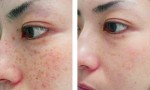 Đắp gừng lên nốt tàn nhang theo cách này, 15 ngày sau bạn sẽ phải “ngỡ ngàng” với chính mình